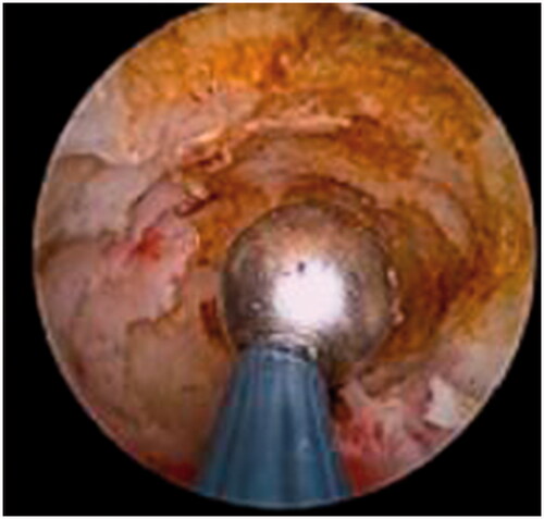 Figure 1. Hysteroscopic excision and suture of scar diverticulum.