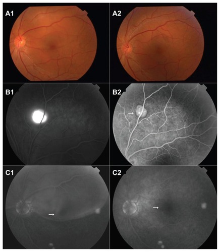 Figure 3 Case 3: Color photography shows bullous retinal detachment located superior to the disk and fovea (A1). Note the large fluorescein staining area superior to the disk (B1), two leaking spots at the inferotemporal quadrant and fluorescein accumulation in the subretinal space superior to the macula (B3). Post-treatment color fundus photography shows subsidence of bullous retinal detachment (A2). Decrease of fluorescein leakage (B2). Fluorescein staining remained with no obvious enlarging in FA (B4).