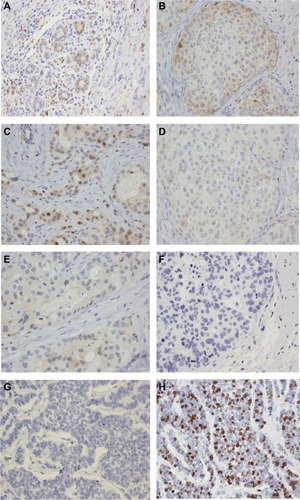 Figure 2 Immunohistochemistry showing TP expression in carcinoma of the breast (magnification, 400×). Representative images of immunohistochemistry staining patterns for mixed nuclear/cytoplasmic TP protein in normal epithelium and in primary or metastatic lesions.
