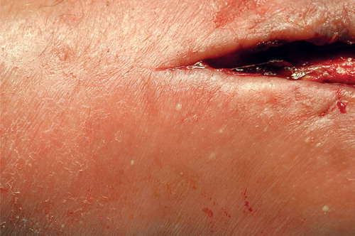Figure 1 A. At synovectomy after 4 weeks. Pustules in skin adjacent to the ulceration margins.