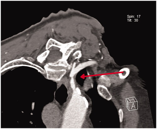 Figure 2. Subclavian stenosis of left subclavian artery (CTA).