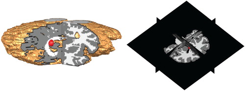 Figure 5. Position of the initial tumour cell density in the MRI T1 image and its corresponding 3d planes.