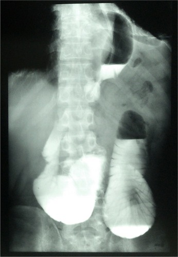 Figure 2 Preoperative barium enema shows dilated intestinal segments detected above the line of the diaphragm. The mediastinum is shifted to the right side.