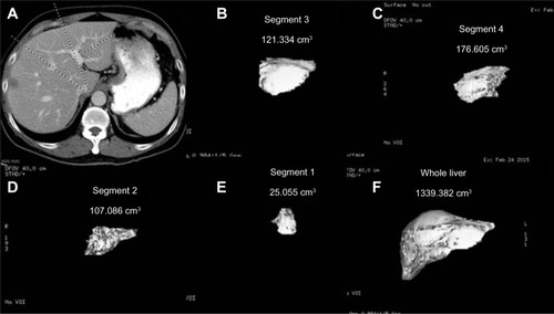 Figure 22 Liver volumetry.