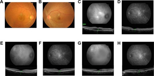 Figure 2 Case 1, a 36-year-old man with blurred vision in his right eye. (A) A fundus photograph of the right eye showing a serous retinal detachment at the fovea. (B) Fundus photograph of the left eye is normal. (C and D) ICGA showed bilateral choroidal vascular hyperpermeability in middle-phase. The subfoveal choroidal thickness at the baseline was 452 μm in the right eye and 351 μm in the left eye. (E and F) After PDT, the subfoveal choroidal thickness in his right eye decreased to 370 μm at week 4. However, the subfoveal choroidal thickness in the left eye increased to 494 μm, with ICGA indicating aggravation of his choroidal vascular hyperpermeability. (G and H) At week 11, in his left eye, ICGA showed aggravation of choroidal vascular hyperpermeability in middle-phase, with a subfoveal choroidal thickness of 470 μm.