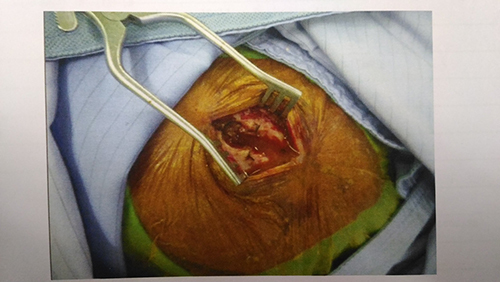 Figure 2 Intraoperative burr hole drainage gross photograph showing large amount of brown-yellow pus in subdural space.