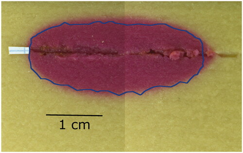 Figure 4. Axial cross-section of post-ablation thermochromic gel phantom. During the experiment, the temperature in the phantom exceeded 70° C in the magenta zone. The blue outline marks the same zone predicted by the model.