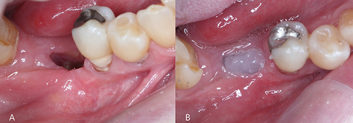 Figure 4 Thirty days of follow-up after surgical debridement (A) and topical application of blue®m oral gel (B).