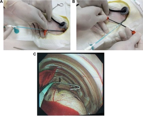 Figure 1 Photographically, the deployment process of the drug-eluting catheter (A) Upon removal of the dilator, the catheter was promptly inserted through the peel-away sheath. (B) The sheath was peeled away. (C) Confirmation of the proper catheter placement by fiberoptic bronchoscopy.