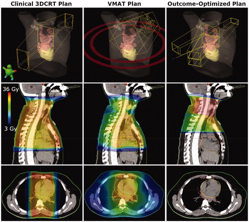 Figure 2. Comparison of beams and dose distributions for clinical 3DCRT, VMAT, and outcome-optimized (O-OPT) plans for an example patient with a large benefit (patient 3 in Table S5). The CTV is shown in pink and the heart is shown in yellow. The PTV is shown in cyan for the VMAT plan.
