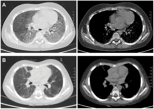 Figure 1 Representative chest CT images of a pediatric PCP patient (Case 13) on admission and discharge. (A) Chest CT images on admission showing diffuse ground-glass opacities in bilateral lungs. (B) Chest CT images on discharge showing that the majority of the bilateral pulmonary lesions were absorbed after anti-PCP treatment.