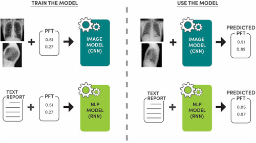 Figure 1 Study overview. The Image Model (CNN = convolutional neural network) is trained using frontal and lateral chest radiograph images and pulmonary function test (PFT) data: FEV1/FVC and FEV1. For 70% of the dataset, the PFT is within 15 days of the chest radiograph, overall within 180 days. The Natural Language Processing (NLP) Model is trained using the associated radiologist text report for the chest radiograph and the PFT data. Two NLP models are used: recurrent neural network (RNN) and state-of-the-art transformer architecture. The Image Model and NLP Model are used in the testing phase to predict PFT values, and therefore the presence or absence of obstructive lung disease.