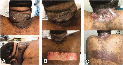Figure 4. A 30-year-old male, BMI 48.5 kg/m2, Fitzpatrick skin type 5, giant AKN. (A) Intraoperative view of 25.5 × 15 cm ‘keloid-type’ lesion treated with wide local excision, complex partial wound closure and split thickness skin graft. Specimen weight: 815 g. (B) Initial dressing change. Donor site and STSG during first postoperative visit in outpatient clinic (postoperative day 6). Partial take of the skin graft treated with local care and systemic antibiotics. Of note, there are multiple skin openings on the area from underlying epidermal inclusion cysts; superficial biofilm also noticed. (C) Long-term follow-up (postoperative day 61). Local condition on grafted area and donor site.