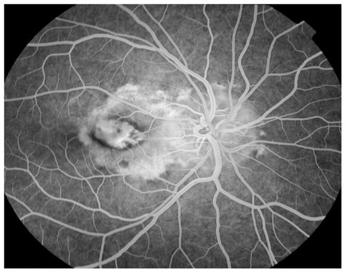 Figure 5 Initial fluorescein angiography.