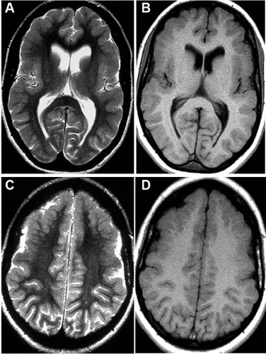 Figure 2 Axial Spin-Echo T2-weighted (A, C) and T1-weighted (B, D) magnetic resonance imaging study of the brain.