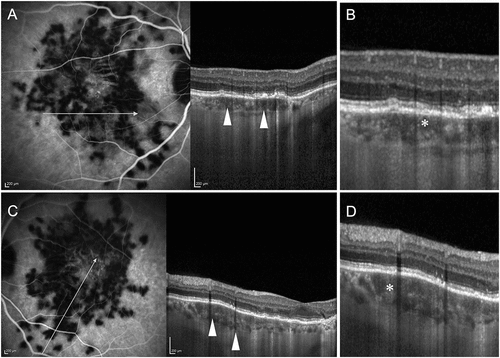 Figure 3. A patient with bilateral choroiditis lesions of acute posterior multifocal placoid pigment epitheliopathy (APMPPE). The right eye (A) shows indocyanine green angiography (ICGA) with hypofluorescent areas suggestive of active choroiditis and perfusion defects. The corresponding optical coherence tomography (OCT) (B) shows an increase in the height of the choriocapillaris slab (white asterisk) with loss of the normal dotted pattern, suggestive of choriocapillaris ischemia. The left eye (C) ICGA image shows a similar pattern of hypofluorescence due to perfusion loss. The OCT (D) of the left eye also shows changes in the choriocapillaris layer with thickening and loss of the normal dotted pattern (white asterisk).