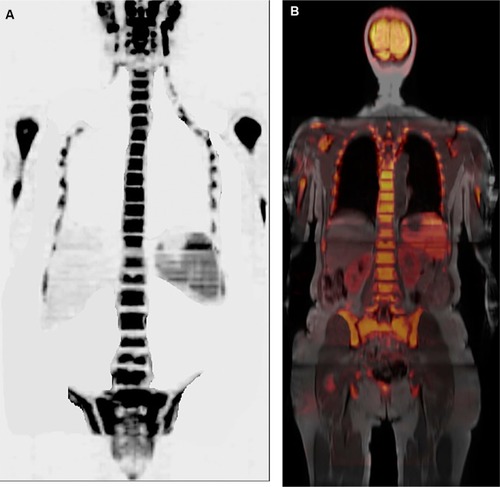 Figure 11 A 71-year-old female patient, undergoing treatment with G-CSF, underwent whole-body MR with diffusion-weighted images (b800) with three-dimensional reformatted MIP in inverted grayscale in the coronal plane (A) and post-processing with fusion of in-phase T1 sequence and b800 diffusion-weighted sequence in the coronal plane (B) showing diffuse hyperplasia of the hematopoietic marrow secondary to the use of G-CSF, characterized by extensive diffusion restriction in bone structures.Note: The spleen and salivary glands have restricted diffusion even in the absence of disease, as shown.Abbreviations: G-CSF, granulocyte colony-stimulating factor; MIP, maximum intensity projection; MR, magnetic resonance.