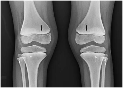 Figure 3. Antero-posterior radiograph of the knees demonstrates a thick, radiopaque metaphyseal band across the femur (black arrows), tibia (white arrows), and fibula (dotted white arrows).