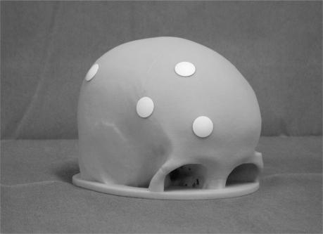 Figure 2 A) Photograph of the skull model showing the newly designed burr-hole buttons filling the burr holes at the tuber frontale, tuber parietale, frontal bone surrounding the linea temporalis and frontal bone 3 cm lateral to the midline. B) Photograph (tangential view) showing the burr-hole button with curvature radius of 30 mm placed in the burr hole defect at the tuber frontale. The border between the button and the surrounding skull model is smooth. C) Photograph (tangential view) showing the conventional burr-hole button placed in the burr hole defect at the tuber frontale. The border between the button and the surrounding skull model is irregular.