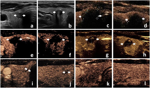Figure 3. The US and contrast-enhanced ultrasound (CEUS) images were obtained in a 64-year-old male with papillary thyroid carcinoma adjacent to the trachea in the right thyroid lobe. (a,b) transverse and longitudinal planes of US images of the tumor (arrows) before RFA; (c,d) CEUS images illustrating non-enhancement in the ablation area (arrows) immediately after RFA; (e,f) CEUS images of the ablation area (arrows) at 1-month follow-up; (g,h) CEUS images of the ablation area (arrows) at 3-months follow-up; (i,j) the ablation area displaying scar-like non-enhancement (arrows) at 12-month follow-up; (k,l) the ablation area completely disappeared at the 18-month follow-up.