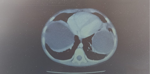 Figure 2 Chest CT scan showing large bilateral thick-walled lung cystic lesions located in the lower segments of the upper lobe.
