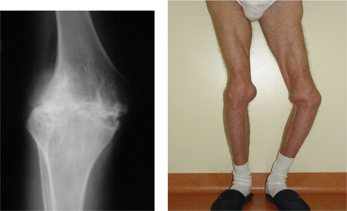 Figure 1. Severe arthropathy in a 65-year-old severe haemophilia A patient born before the advent of modern FVIII replacement therapy.