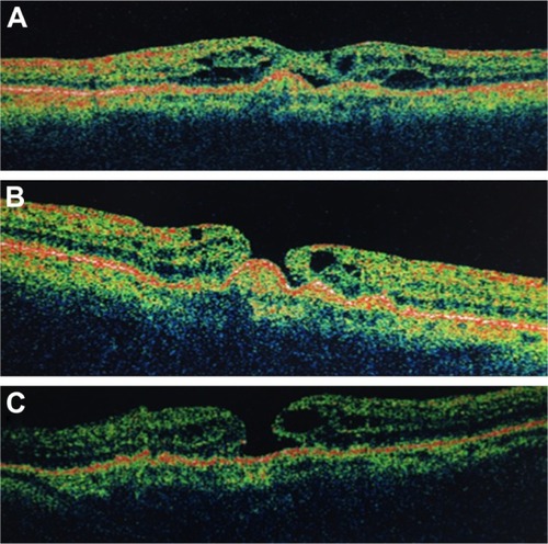 Figure 2 57-year-old female patient who developed full thickness macular hole after ranibizumab injections for age-related macular degeneration.