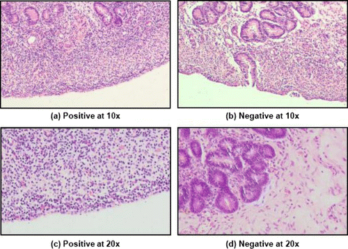 Figure 1(a–d). Histopathological characterization performed on uterine tissue samples obtained from morbid genitalia showing positive and negative for endometritis. Lymphocyte-rich cellular infiltration and the presence of polymorphonuclear cells indicate positive for endometritis, inert quiescent uterus and the absence of cellular infiltration indicate negative for endometritis.