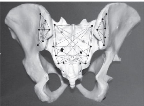 Figure 15. Markers placed in the sacrum and the innominate bone. The markers represent a marker segment, and the movement between these segments is calculated by the computer.