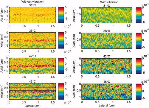 Figure 9. 2 D gradient maps in ex vivo bovine muscle tissue obtained using the conventional echo-shift technique without (left) and with (right) presence of vibration in the tissue. The temperatures measured by the inserted thermocouple were 31, 38, 42 and 46 °C at the center of heated region. The color bars represent the axial gradient of the cumulative time shifts in units of s/m. The horizontal rectangles are the regions of interest for calculating the CNR and SNR.