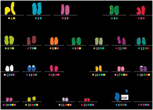 Figure 3. Multicolor FISH (M-FISH) analysis showing a marker chromosome is derived from the chromosome X. M-FISH preparation of a karyotype showing the normal X-chromosome and the marker chromosome which was derived from the X chromosome.