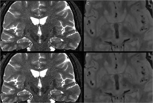 Figure 1. Direct identification of subthalamic nucleus (STN) on T2 TSE coronal 3-T MR images (A and B) and of the nucleus ventralis intermedius (VIM) on TSE dual-echo axial DP 3-T MR images (C and D).