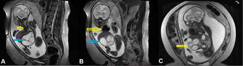 Figure 2 Magnetic resonance imaging (MRI) showed (A) sagittal view shows roots of four pulmonary veins (yellow arrow) and dilated bowels (blue arrow). (B) Sagittal view shows a four-chamber heart (yellow arrow) and dilated bowel (blue arrow). (C) Coronal view shows extrude liver and dilated bowel outside the abdomen (yellow arrow).