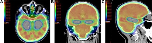 Figure 1 Radiotherapy planning image with the dose distribution illustrated in color.