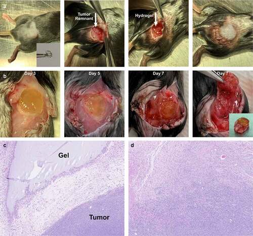 Figure 1. Experimental model of incomplete tumor resection. (a) (Left to right) Panc02 flank tumors were allowed to grow to 1 cm in diameter prior to incomplete resection, leaving a 1 mm rim of tumor on the muscle bed (arrow). A hyaluronic acid hydrogel disc (inset) was implanted adjacent to the tumor bed and the wound closed with sutures and clips. (b) (Left to right) Tumors and surrounding granulation tissue were excised on postoperative day 3, 5 and 7. (Far right) Dissection of the tumor remnant is shown with the final specimen (inset) for either histology or flow cytometry. (c) H&E stain demonstrating the interface between the hydrogel and tumor recurrence. (d) H&E demonstrating tumor regrowth adjacent to postoperative scar and granulation tissue