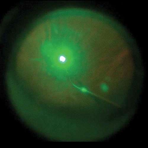 Figure 4. During laser photocoagulation, the surgeon sometimes experienced nausea and dizziness when looking at the display. The flash-like images also made some of the assistants uncomfortable.