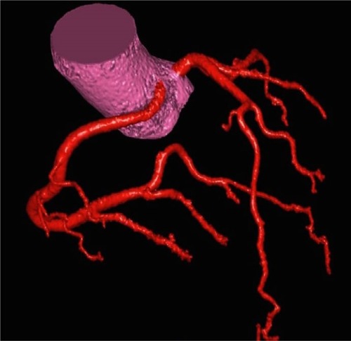 Figure 1 Coronary angiogram depicted in color to show origination of right and left coronary arteries from the left aortic cusp.