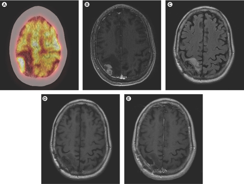Figure 3. Case 3 images. PET CT showing hypermetabolic right parietal lesion (A). Post-gadolinium MRI showing enhancing lesion corresponding to hypermetabolism (B). FLAIR image showing edema surrounding the lesion (C). Post-treatment pre-contrast MRI showing resection cavity (D). Post-treatment post-gadolinium MRI showing essentially complete resolution of the enhancing lesion (E).