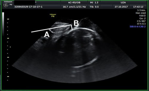 Figure 1 SHD is measured by drawing a line through the symphysis (A) and from the end of the symphysis a second line perpendicular to the fetal skull (B); the last line is the SHD.