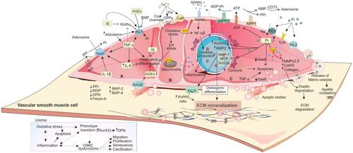 Figure 2 The impact of uremic toxins on CKD-induced VSMC dysfunction and VC. Due to hyperphosphatemia, hypercalcemia, elevated oxidative stress, and inflammation,Citation132 VSMCs manifest dysregulated functions and phenotype. Uremic toxins including Pi, IS, AGEs, IL-1β, IL-6, and TNF-α are involved in CV. (A) IL-1β, IL-6, and TNF-α induce osteoblast-like trans-differentiation of VSMCs through different mechanisms.Citation16 Interaction of AGEs with their receptor (RAGE) induces the expression of Pit-1 via ROS productionCitation49 and leads to osteogenic transition. It also causes apoptosis through NAD(P)H oxidase-derived oxidative stress.Citation133 (B) In CKD, normal Ca homeostasis is also dysregulated. This homeostasis is mediated by klotho, PTH, active vitamin D metabolites, and calcitonin. In VSMCs, Ca signaling is mediated by Ca channels, CaR, and pumps that maintain Ca concentrations in these cells.Citation134 Higher level of extracellular Ca is associated with the release of MVs and cell death promotion and release of apoptotic bodies.Citation43 (C) Extracellular Pi, as a signaling molecule, can trigger numerous changes in VSMCs through regulating different molecular pathways. NPP1 is responsible for extracellular ATP degradation to AMP and PPi, CD73 degrades AMP to adenosine and Pi and TNAP breaks PPi into phosphate and adenosine.Citation15 Higher Pi level simultaneously upregulates the expression of osteo/chondrogenic genes (Runx2, ALP, OPN, and osterix) and downregulates VSMCs genes (SM22α and αSMA). ALP controls vascular matrix mineralization by degradation and inactivation of the VC inhibitors (PPi and P-OPN) to allow uncontrolled tissue mineralization and simultaneously releasing free Pi.Citation43 These osteo-/chondroblast-like cells actively induce apoptosis and vesicle release, a reduction in calcification inhibitors, elastin degradation, increased ECM remodeling, and a pro-inflammatory state. Moreover, under high levels of Pi, VSMCs synthesize collagen at high amount and provide a collagen-enriched ECM. Downregulation of Gas6 and Bcl2 may be the basic mechanism of VSMCs apoptosis. The released apoptotic bodies provide a further nidus for deposition of Pi and Ca. For more details, see the full text.Abbreviations: Ca, calcium; Pi, phosphate; PPi, pyrophosphate; ECM, extracellular matrix; MMP, matrix metalloproteinases; Gas6, growth arrest-specific gene 6; ALP, alkaline phosphatase; ROS, reactive oxygen species; SM, α-smooth muscle actin; CPPs, calciprotein particles; CaR, Ca sensing receptor; MVs, matrix vesicles; AGEs, advanced glycation end products; RAGE, receptor for advanced glycation end products.