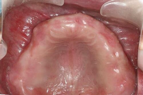 Figure 23 Upper occlusal view 10 years after treatment (flipped mirror image).