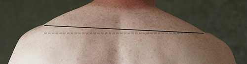 Figure 4 Postural deformity with shoulder asymmetry, recurrent tightness and pulling in the playing-associated higher left shoulder in a 63-year-old amateur flautist. History of 54 years of transverse flute playing and >30,000 cumulative practice hours (max. 2h/day).
