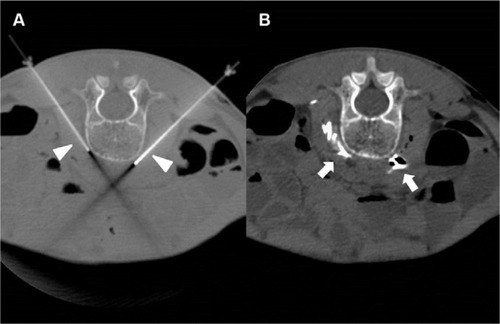 Figure 2 CT fluoroscopy images patient 1Notes: (A) Axial CT fluoroscopy image obtained at the level of the L3 vertebral body shows simultaneous placement of 21 G 15 cm needles (arrowheads) into the prevertebral space via a posterior approach. (B) The final axial CT image obtained at the same level following drug and contrast administration shows dispersion of contrast material (arrows) in the prevertebral space corresponding to the location of the lumbar sympathetic chains.