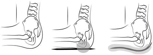 Figure 1. Pressure distribution on buttocks, showing no cushion, a flat cushion, and a contoured cushion, respectively.