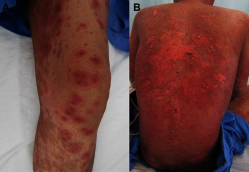 Figure 3 A 33-year-old Thai female diagnosed with erythema multiforme–like acute cutaneous lupus erythematosus (ACLE) and subsequent progress to toxic epidermal necrolysis–like ACLE. (A) The patient presented with fever and typical target-like lesions on the left forearm and left legs for 5 days. (B) Widespread erosions and sloughing of the skin involving 40% of BSA developed 3 weeks later.