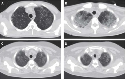 Figure 1 Computed tomography (CT) showed ground-glass opacities in the apexes of both lungs in the initial phase of Pneumocystis pneumonia (PCP). (A) A 31-year-old male patient underwent parental-origin renal transplantation (RT) after 3 years of hemodialysis, and PCP occurred 7 months after RT. In the early stages, CT showed ground-glass opacities in the apexes of both lungs. (B) A 37-year-old female patient underwent RT after 8 years of hemodialysis, and PCP occurred 3 months after surgery. CT showed a decrease in the transmittance of the two lungs, and diffuse, plaque-like, and strip-like opacities were seen in both apexes. (C) A 30-year-old male patient underwent RT after 1 year of hemodialysis, and PCP occurred 3 months after RT. CT showed increased clouding and ground-glass opacities in the apexes of both lungs, and the edges were unclear. (D) A 39-year-old male patient underwent RT after 5 years of hemodialysis, and PCP occurred 3 months after surgery. CT showed ground-glass and strip-like, high-density shadows scattered across the apexes of both lungs.