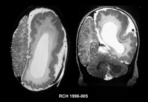 Figure 3. Imaging features of hemimegalencephaly. Axial T2-wieghted MRI (left) and coronal T2 -weighted MRI (right) of an infant with hemimegalencephaly showing an enlarged and dysmorphic left hemisphere containing an enlarged lateral ventricle, periventricular heterotopic gray, excessive white matter, abnormal white matter signal, and gyral irregularity suggestive of polymicrogyria, all characteristic of hemimegalencephaly. MRI, magnetic resonance imaging