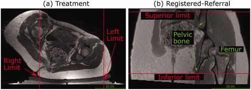 Figure 4. Transducer translation restrictions for volunteer data. Practical restrictions applied to the transducer’s translation capabilities (solid red lines) for volunteer datasets only. (a) For a treatment imaging dataset, the left-right translation was limited by the extent of acoustic coupling between the volunteer’s skin and the gel pad. The corresponding registered-referral imaging dataset shared these left-right restrictions. (b) For a registered-referral imaging dataset, the transducer’s inferiorsuperior translation was restricted by the extent of pelvic bone and the requirement for a full body outline within the image. The corresponding treatment imaging dataset shared these inferior-superior restrictions.