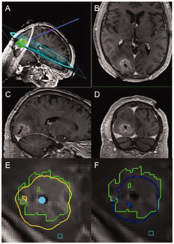 Figure 2. Representative intra-operative MRI of case illustration. (A) A planned LITT trajectory is shown, followed by T1-weighted post-contrast (B) axial, (C) sagittal, and (D) coronal cuts showing catheter placement within the center of the lesion post-ablation. Representative thermal damage threshold lines are shown for the outlined lesion in green at a given depth for (E) protein denaturation in yellow and (F) cell death in blue, obtained during continuously acquired thermal MR imaging that guides the extent of heat application.