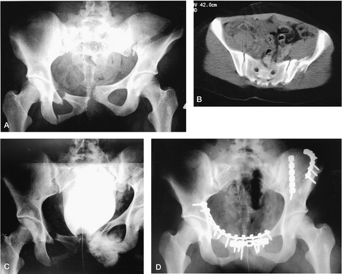 Figure 3. (A) A 19-year-old woman was injured when a tree fell on her during a storm, sustaining a type-C1-1 injury to the pelvic ring. (B) There was a marked vertical and lateral dislocation of the iliac wing. (C) She had a concomitant rupture of the bladder, which was seen in the cystografia. (D) She was operated in the early phase by suturing the rupture of the bladder and by reducing and fixing simultaneously the pubic ramus, the symphysis pubis, and the iliac wing with 3.5-mm reconstruction plates. She had no primary or late complications, and the final functional outcome was good.